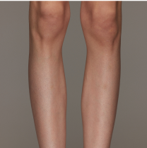 Before and after leg hair removal comparison on a person, showing smoother skin and reduced hair.