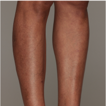 Before and after leg hair removal comparison on a person, showing smoother skin and reduced hair.